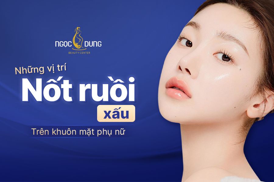 Những vị trí nốt ruốt xấu trên khuôn mặt phụ nữ cần lưu ý