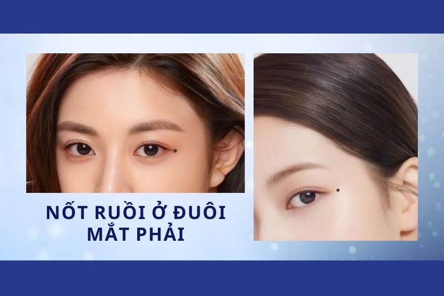 Nốt ruồi ở đuôi mắt phải - Nam thường lập gia đình muộn