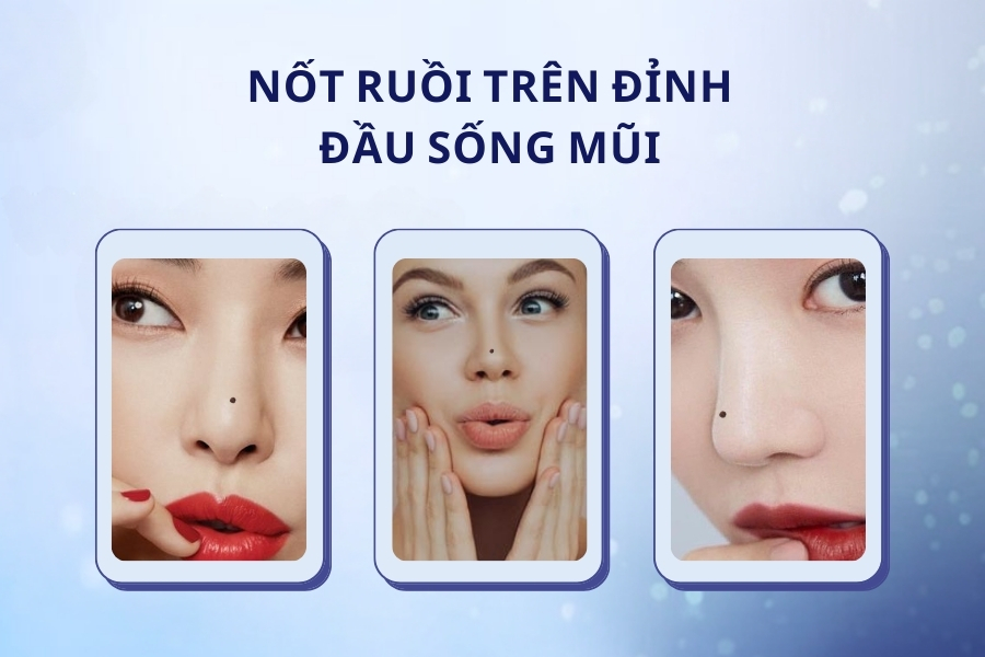 Nốt ruồi lận đận tình duyên nằm ở trên đỉnh sống mũi