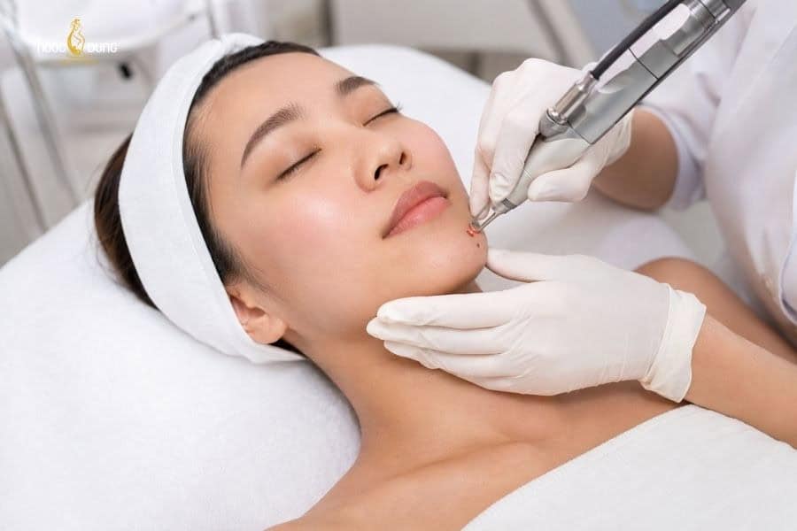 Nốt ruồi có kích thước nhỏ thường xử lý nhanh hơn