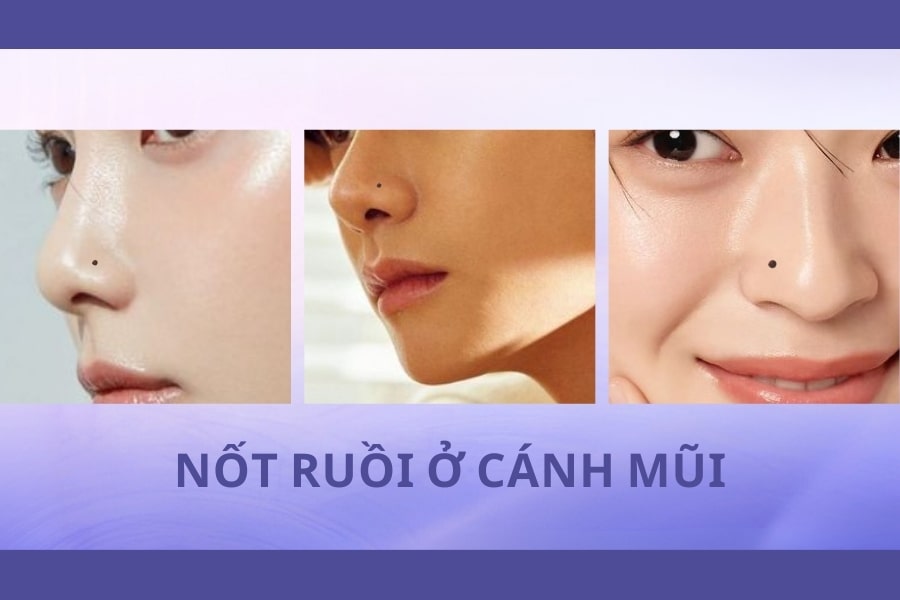 Những nốt ruồi xấu trên mặt - Nốt ruồi ở cánh mũi