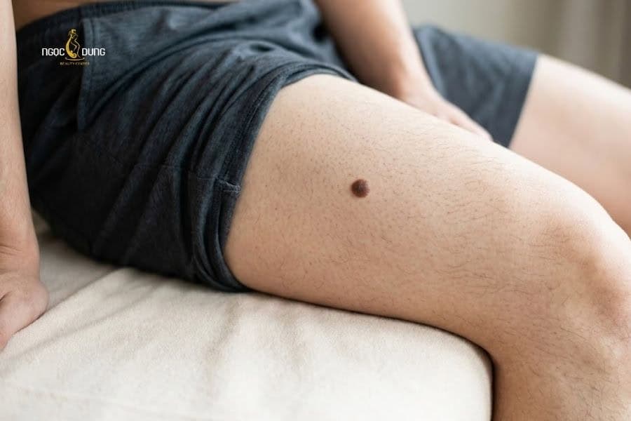 Nam giới có nốt ruồi ở trước đùi thường là người có chí cầu tiến trong công việc