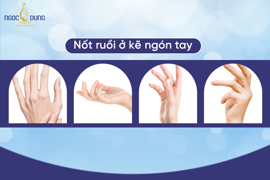 Nốt ruồi ở kẽ ngón tay có ý nghĩa gì? Sung sướng hay vất vả?