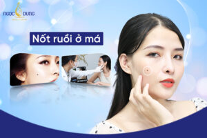 Nốt ruồi ở má tiết lộ điều gì ở tương lai? Có nên xóa không?