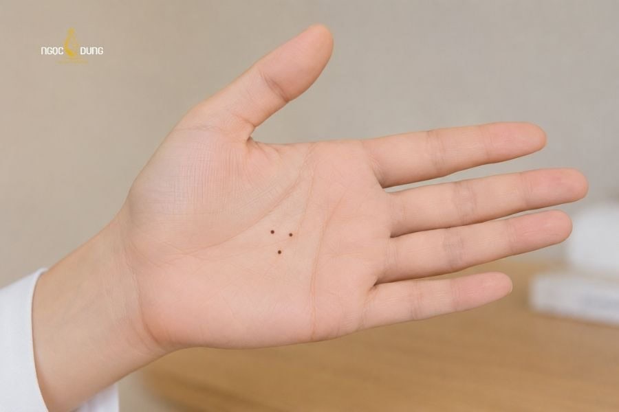 Người có 3 nốt ruồi tạo thành tam giác ở bàn tay thường là người trí tuệ