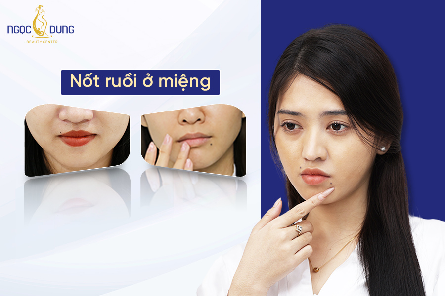 Những nốt ruồi ở miệng có ý nghĩa gì? Có nên tẩy hay không?