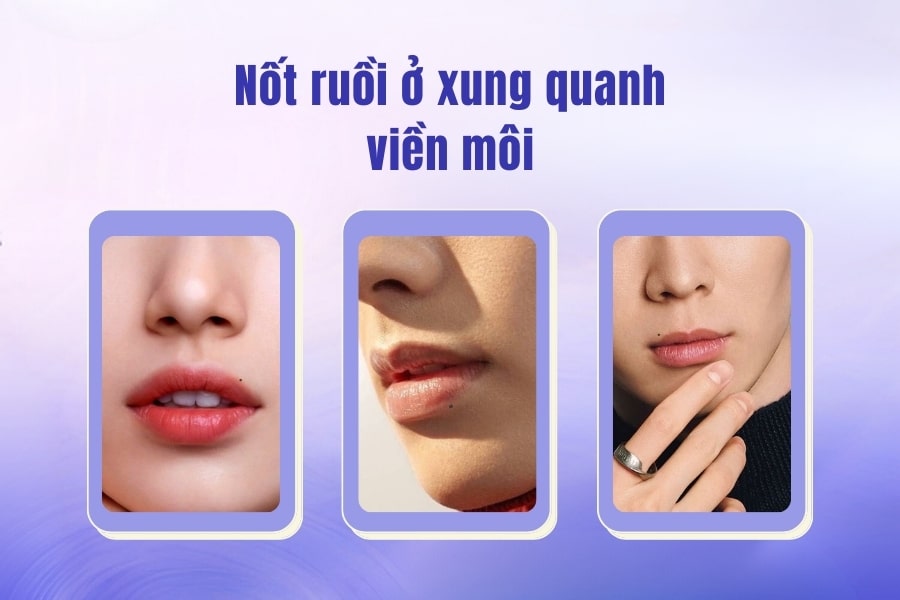 Nốt ruồi ở viền môi trên có nên xóa không?