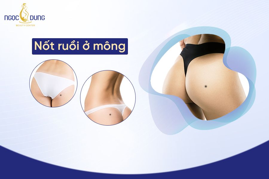 Nốt ruồi ở mông thường mang đến những điềm báo gì? Tìm hiểu ngay