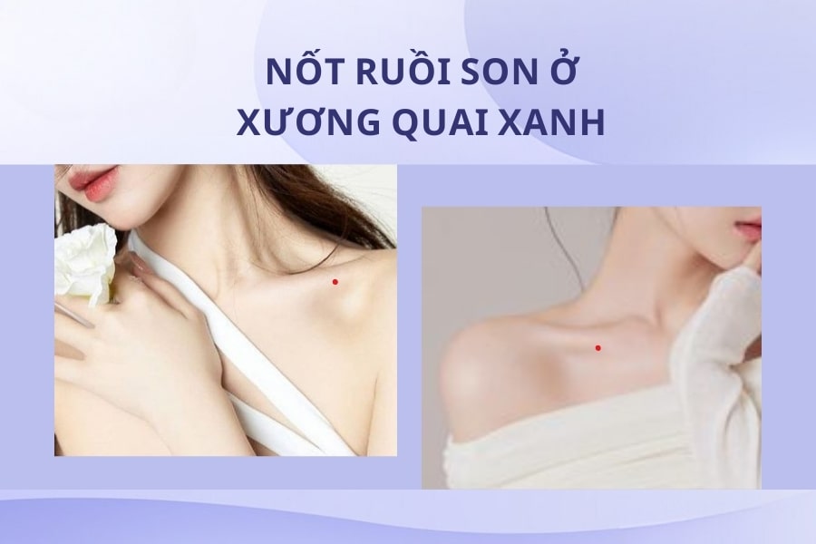 Mụn ruồi son ở xương quai xanh - Trái phải đều có người hậu thuẫn