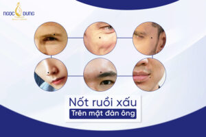 Xem tướng nốt ruồi xấu trên mặt đàn ông đoán ngay tính cách