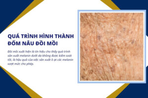 Đồi mồi xuất hiện là tín hiệu cho thấy quá trình sản xuất melanin dưới da không được kiểm soát tốt