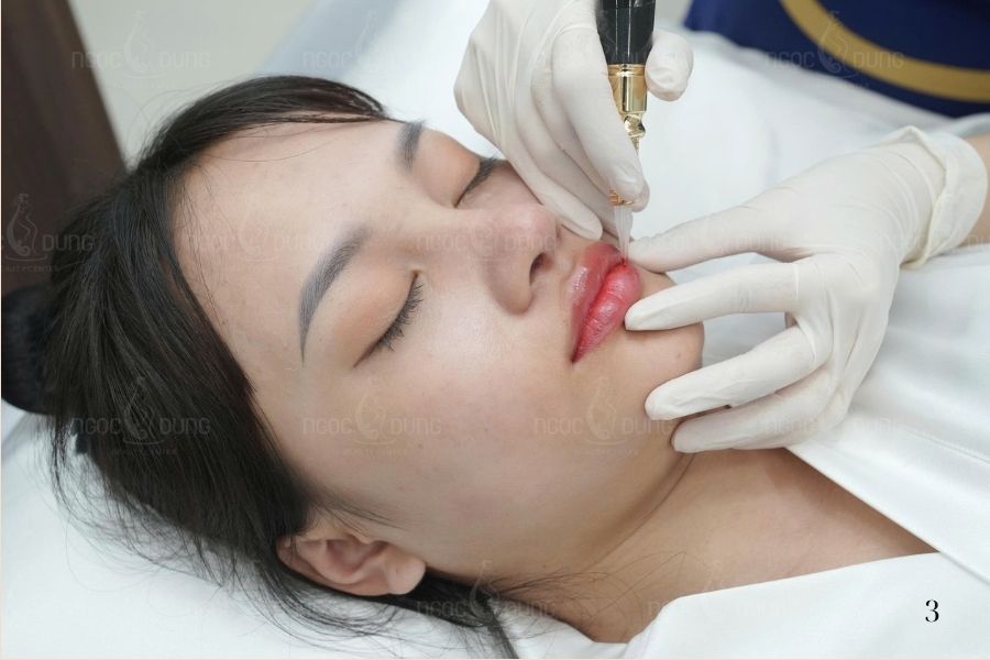 Khử thâm môi phù hợp với trường hợp môi thâm do sắc tố, môi xỉn màu lâu năm hoặc người chưa muốn phun môi