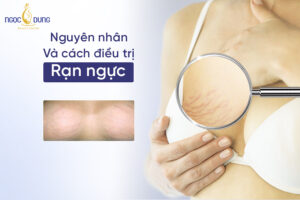 Vết rạn trên ngực