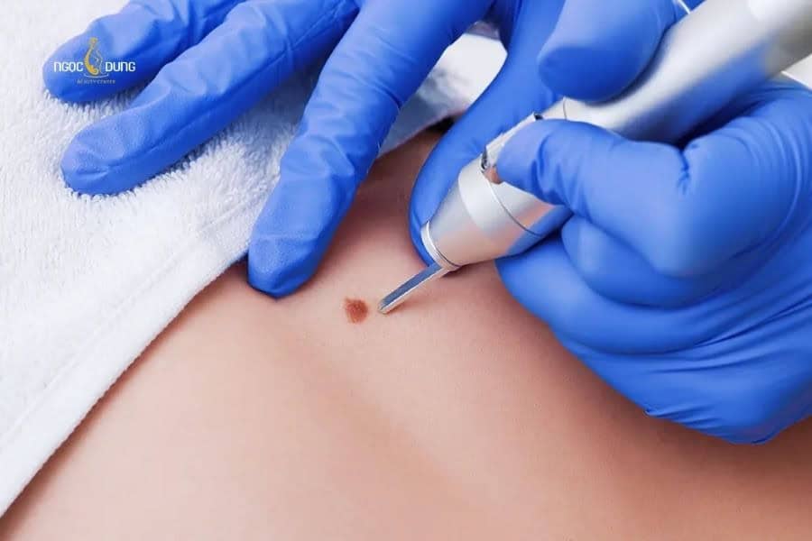 Giá tẩy nốt ruồi bằng tia laser còn phụ thuộc vào số lượng nốt ruồi trên da
