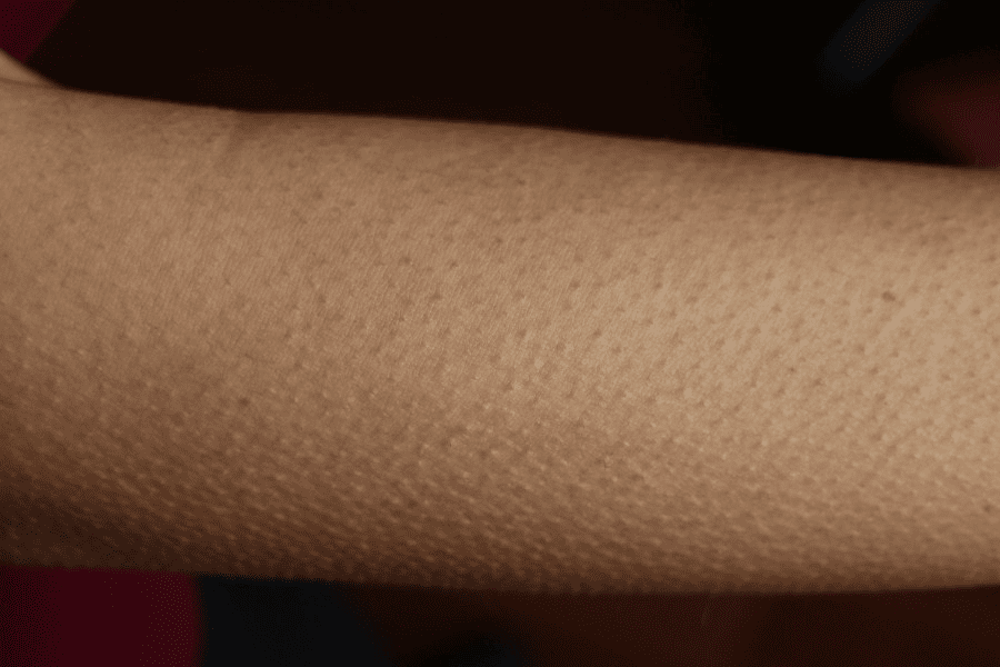 Sự khác nhau giữa tình trạng viêm nang lông và dị ứng thời tiết