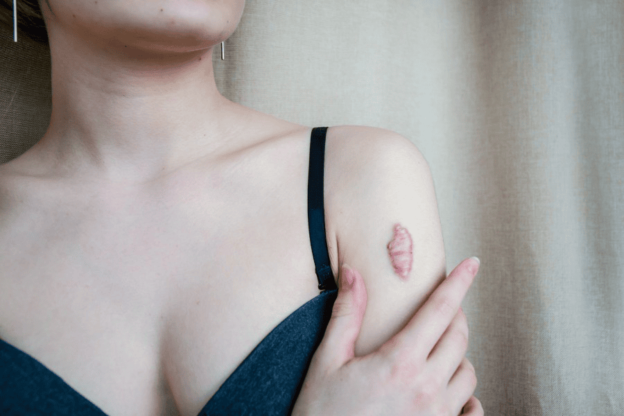 Sẹo lồi ngày càng to: Nguyên nhân và cách điều trị dứt điểm 7 Sự tăng sinh Collagen quá mức trong quá trình hồi phục tổn thương sẽ tạo thành khối u xơ cứng