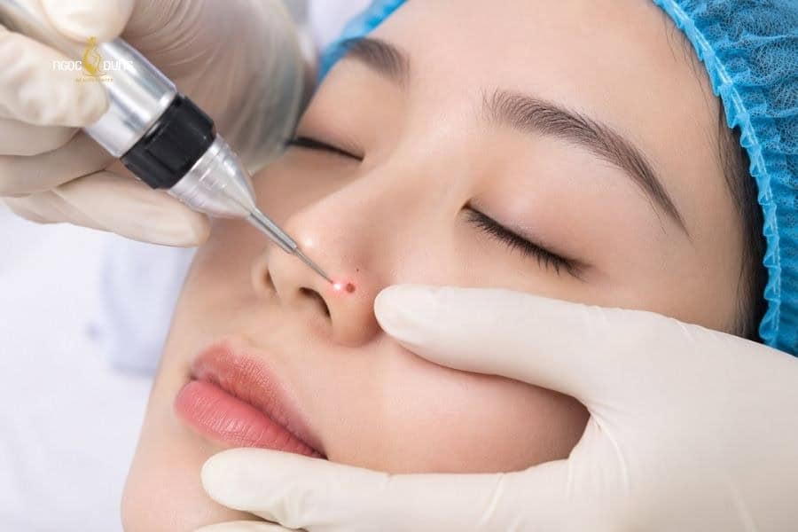Tẩy nốt ruồi kiêng gì để da nhanh hồi phục, không sẹo? 6 Hãy đến Ngọc Dung nếu có nhu cầu xóa nốt ruồi hiệu quả nhanh chóng và an toàn