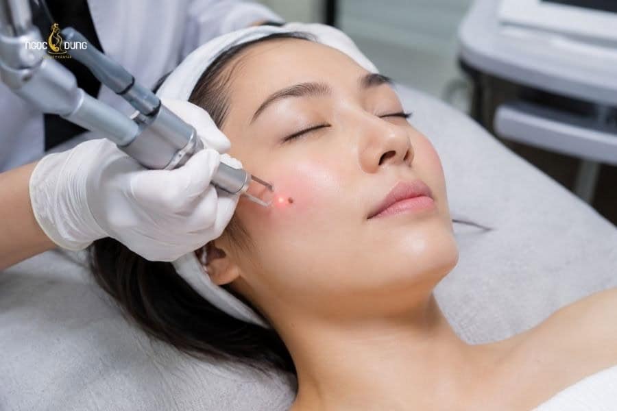 Tẩy nốt ruồi an toàn và êm ái tại Ngọc Dung