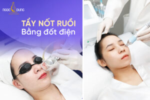 Tẩy nốt ruồi bằng đốt điện là gì? Có an toàn không? Nên làm ở đâu?
