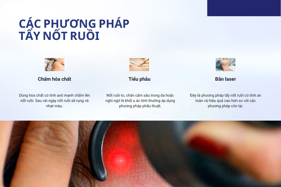 Một số phương pháp tẩy nốt ruồi hiệu quả khác, phổ biến hiện nay