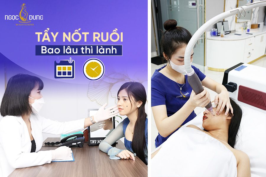 Tẩy nốt ruồi bao lâu thì lành? Giải đáp ngay vấn đề này cùng chuyên gia