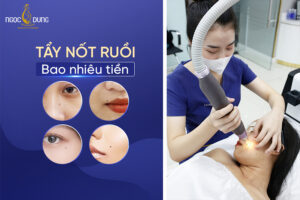 Tẩy nốt ruồi bao nhiêu tiền? Bảng giá mới nhất 2024 
