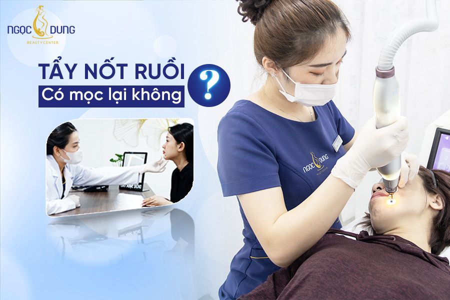 Tẩy nốt ruồi có mọc lại không? Cùng chuyên gia giải đáp ngay