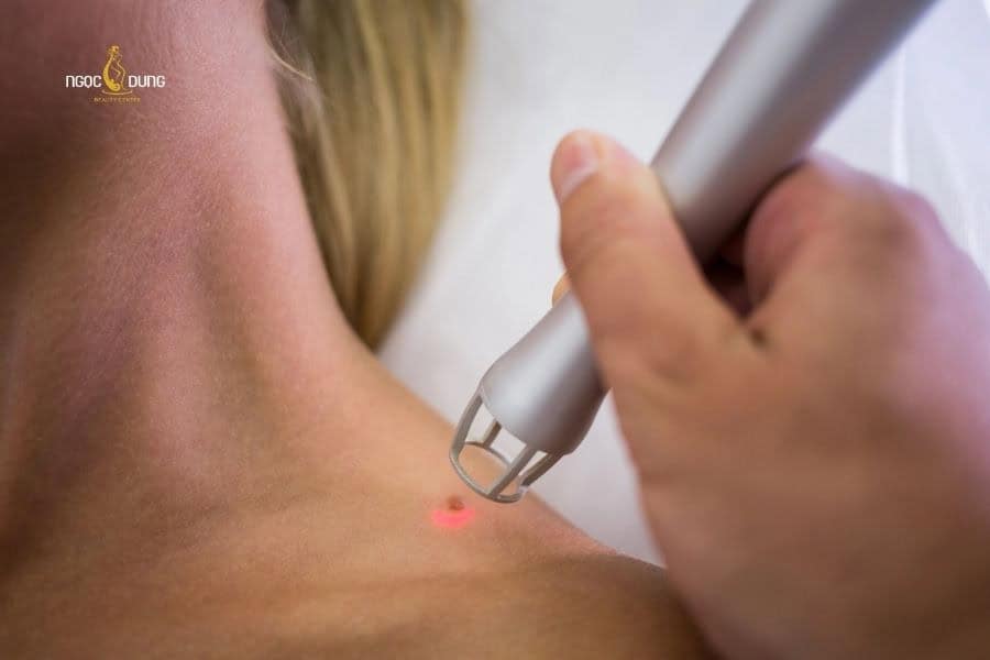 Tẩy nốt ruồi có mọc lại không? Cách tẩy nốt ruồi hiệu quả 4 Laser Fractional CO2 có khả năng xóa sạch chân nốt ruồi và ngăn ngừa tình trạng mọc lại