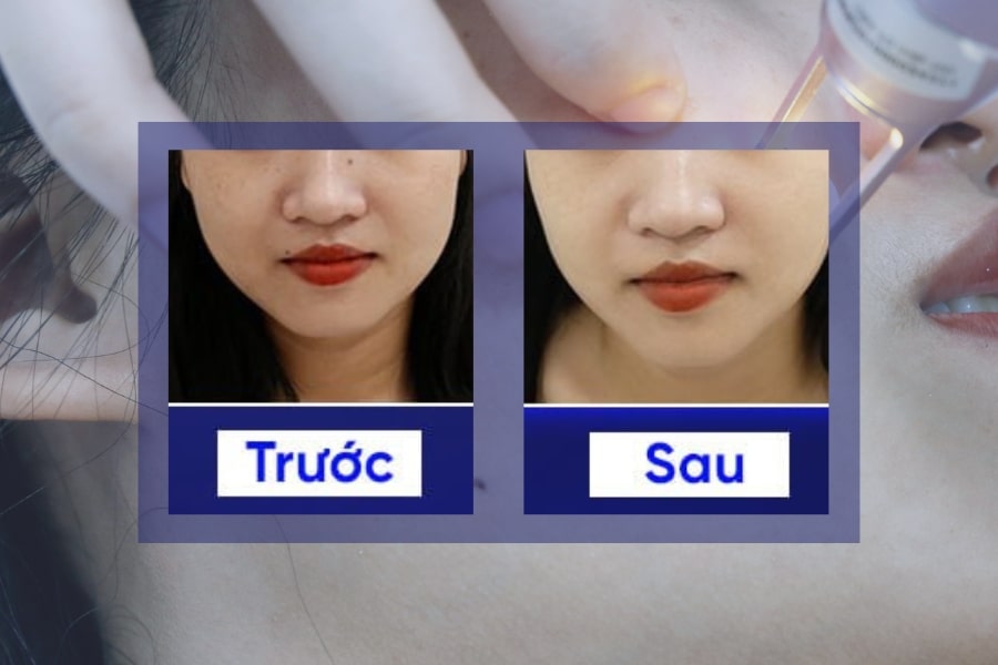 Hình ảnh khách hàng trước và sau khi thực hiện tẩy nốt ruồi tại TMV Ngọc Dung