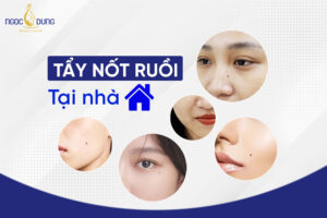 Review 7 cách tẩy nốt ruồi tại nhà được chia sẻ nhiều nhất