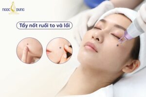 Tổng hợp các cách tẩy nốt ruồi to và lồi hiệu quả mà có thể bạn đang muốn biết