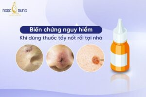 Review thuốc tẩy nốt ruồi tại nhà: Các biến chứng nguy hiểm cần biết