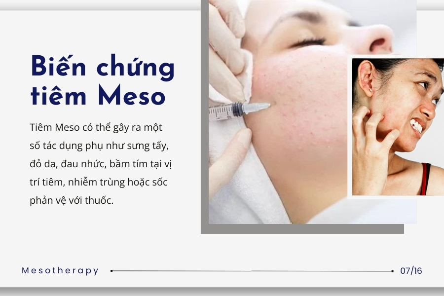 Các biến chứng, tác dụng phụ công nghệ Mesotherapy là gì?