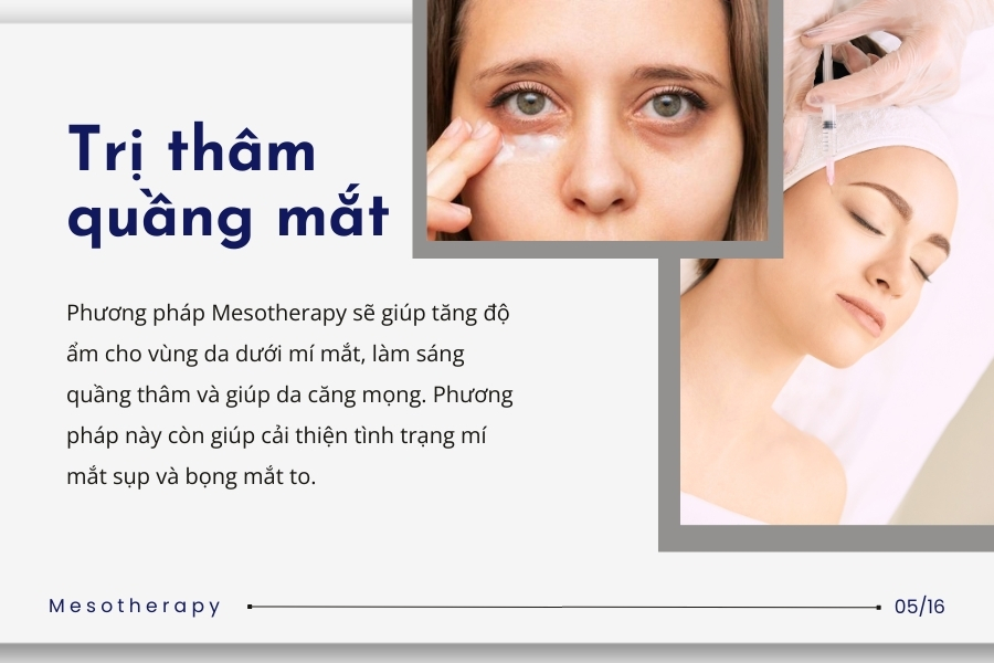 Dùng phương pháp Mesotherapy trị thâm quầng mắt