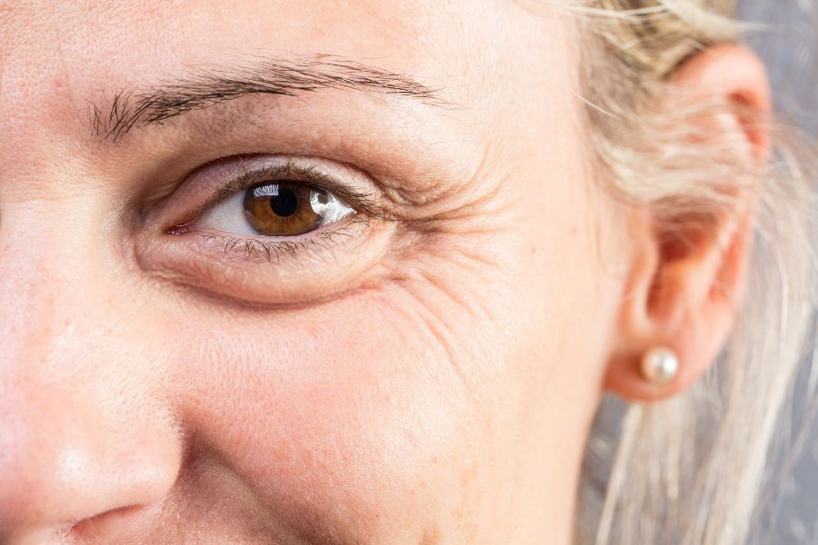 Các dấu hiệu thường thấy của tình trạng lão hóa da vùng mắt