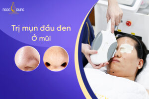 Tổng hợp 13 cách trị mụn đầu đen ở mũi, se khít lỗ chân lông