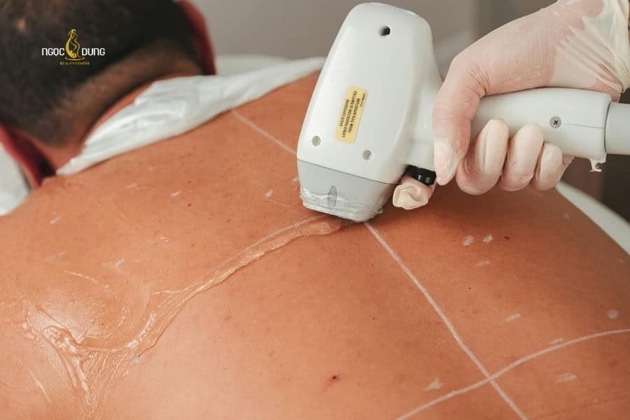 Chi phí triệt lông lưng không giống nhau ở các cơ sở