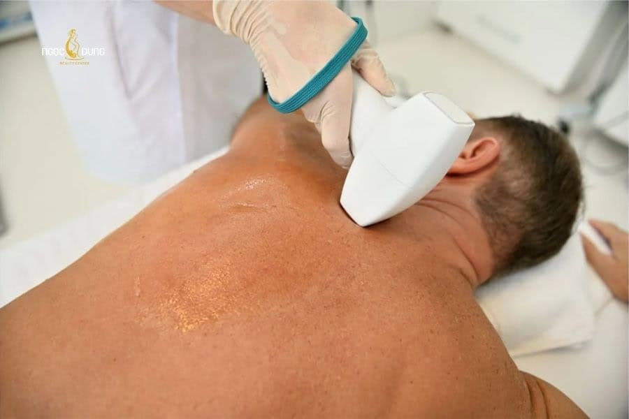 Triệt lông lưng bằng công nghệ cao (Laser hoặc IPL) có thể ức chế sự phát triển của nang lông lâu dài