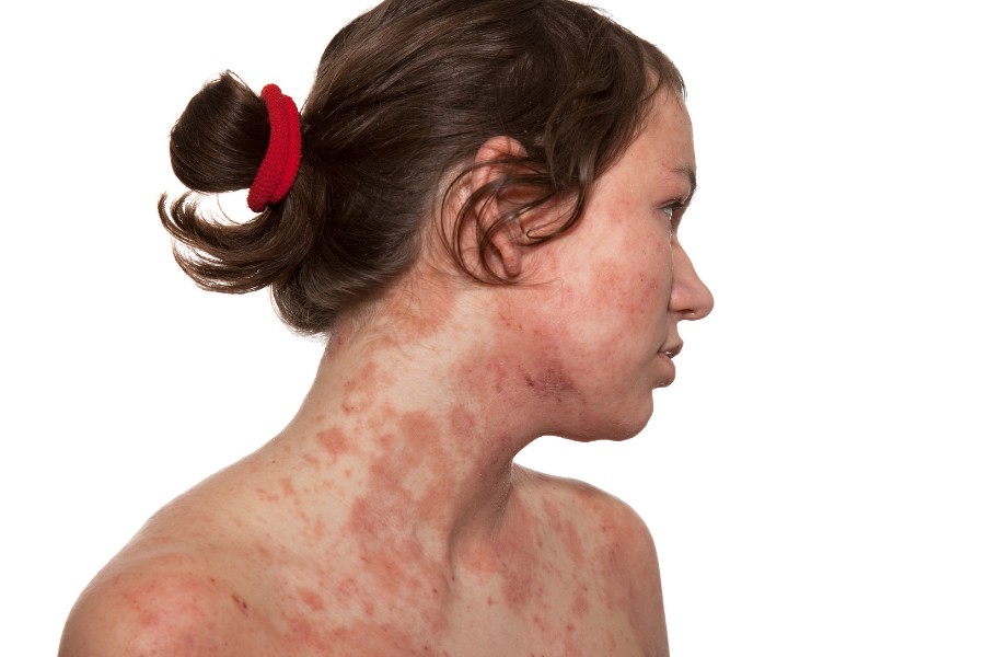 Chàm da mặt là tình trạng viêm da gây ra cảm giác ngứa ngáy sưng và bong tróc