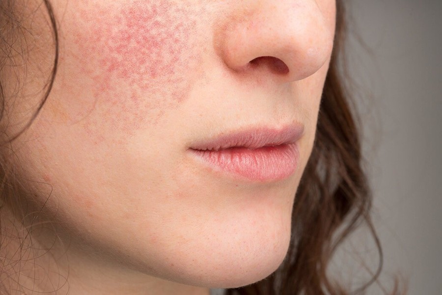Chàm da mặt có thể biểu hiện qua những mảng màu đỏ, lan rộng