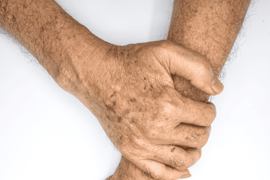 Vết thâm đen da tay là bệnh gì? Nguyên nhân và cách trị 4 Vết thâm đen trên da tay do bị lão hóa da