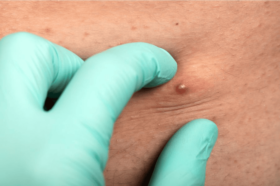 Viêm nang lông vùng kín: Nguyên nhân, dấu hiệu và cách xử lý 10 Viêm nang lông vùng kín có thể để lại vết thâm và gây cảm giác khó chịu