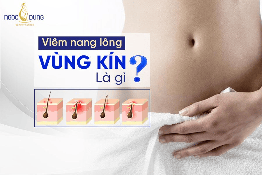 Viêm nang lông vùng kín: Nguyên nhân, dấu hiệu và cách xử lý 2 Viêm nang lông vùng kín là gì? Có ảnh hưởng tới sức khỏe không?