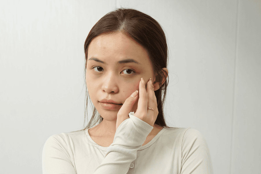 Vùng da mắt trở nên sẫm màu hơn khi bị thiếu ngủ và stress kéo dài