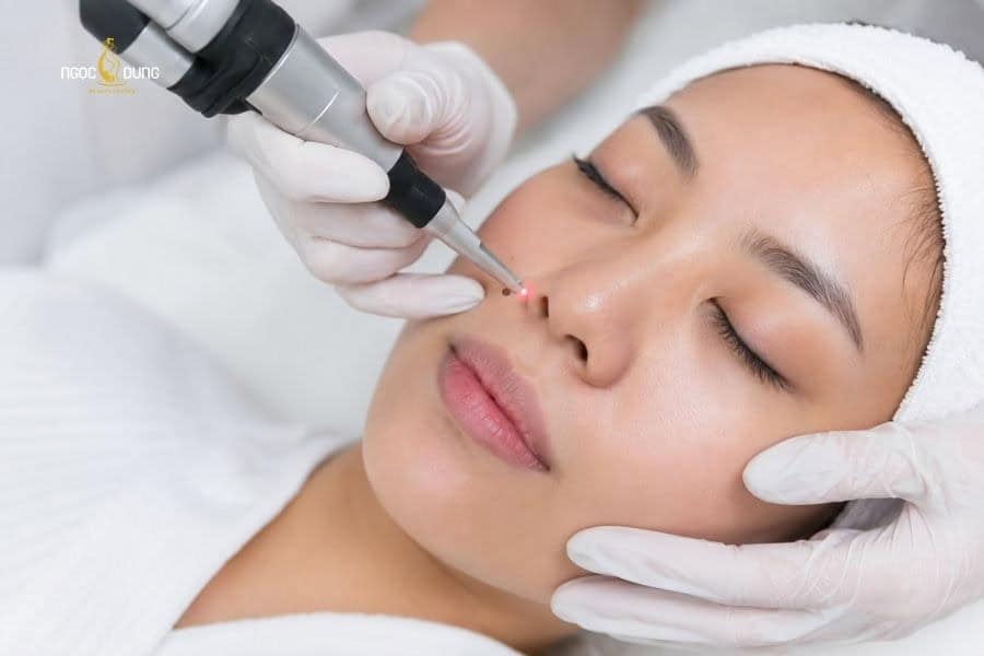 Xóa nốt ruồi an toàn tại Ngọc Dung
