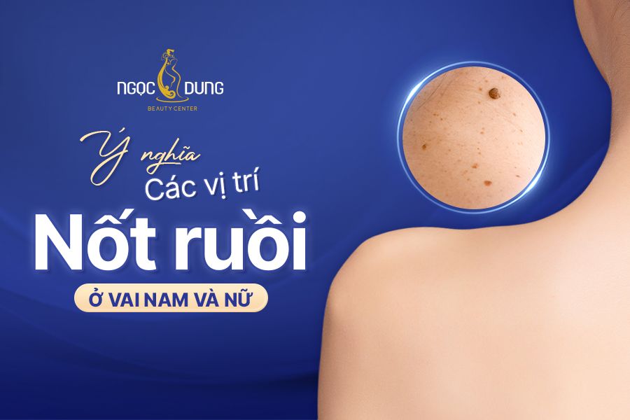 Ý nghĩa các vị trí nốt ruồi ở vai