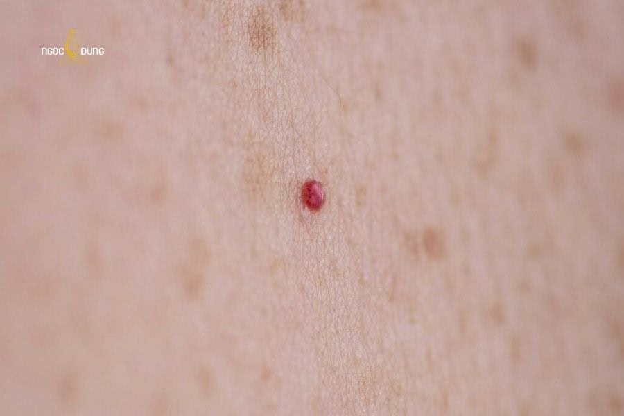 Nốt ruồi son thường mang lại ý nghĩa tích cực trong nhân tướng học