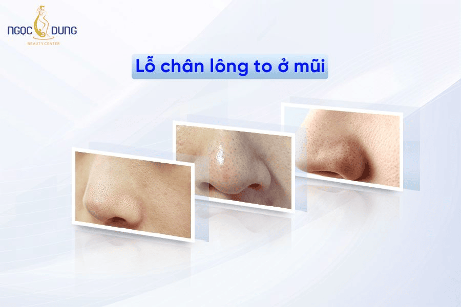 10+ Cách se khít lỗ chân lông ở mũi hiệu quả
