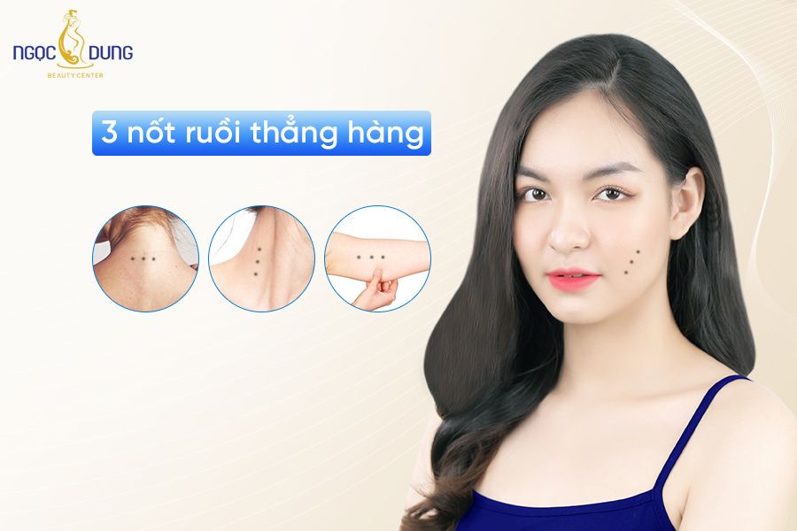 3 nốt ruồi thẳng hàng mang những ý nghĩa đặc biệt gì? Cùng chuyên gia giải đáp ngay