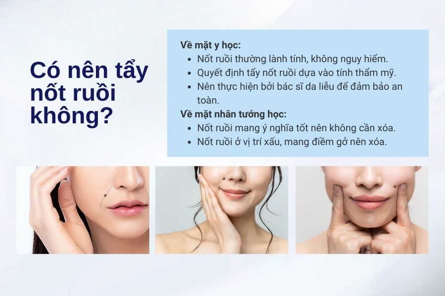 Nốt ruồi ở rãnh cười có nên tẩy không?